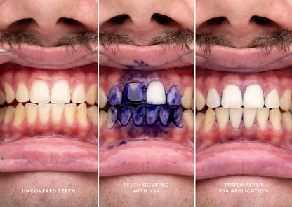 Hismile V34 Purple Teeth Whitening